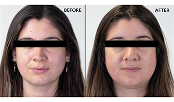 Before and After