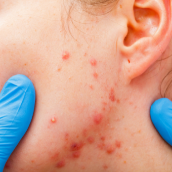 Acne on clients jawline